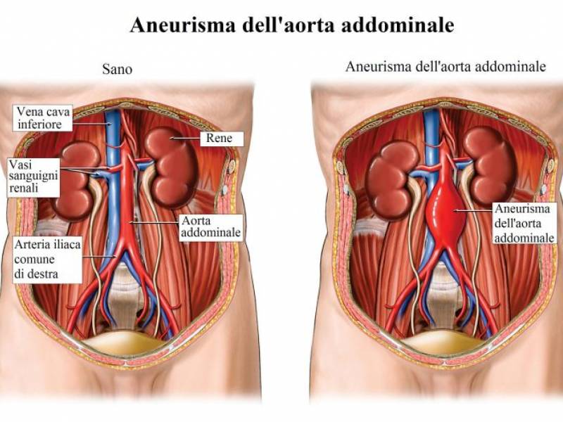 Immagine articolo: Aneurisma dell'aorta addominale, un "killer silenzioso" da dover riconoscere